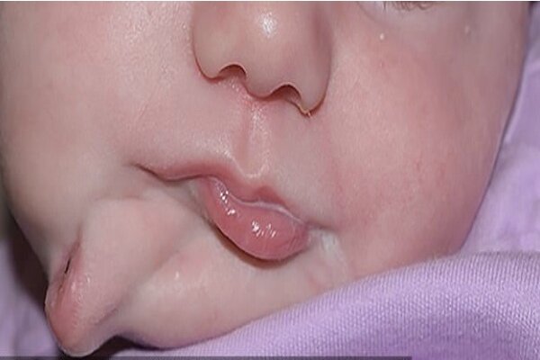 نوزادی با 2 دهان متولد شد/ جراحی موفقیت‌آمیز دهان اضافه