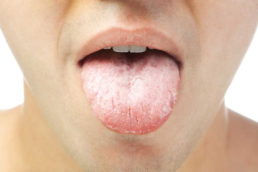 راه‌های درمان خشکی دهان