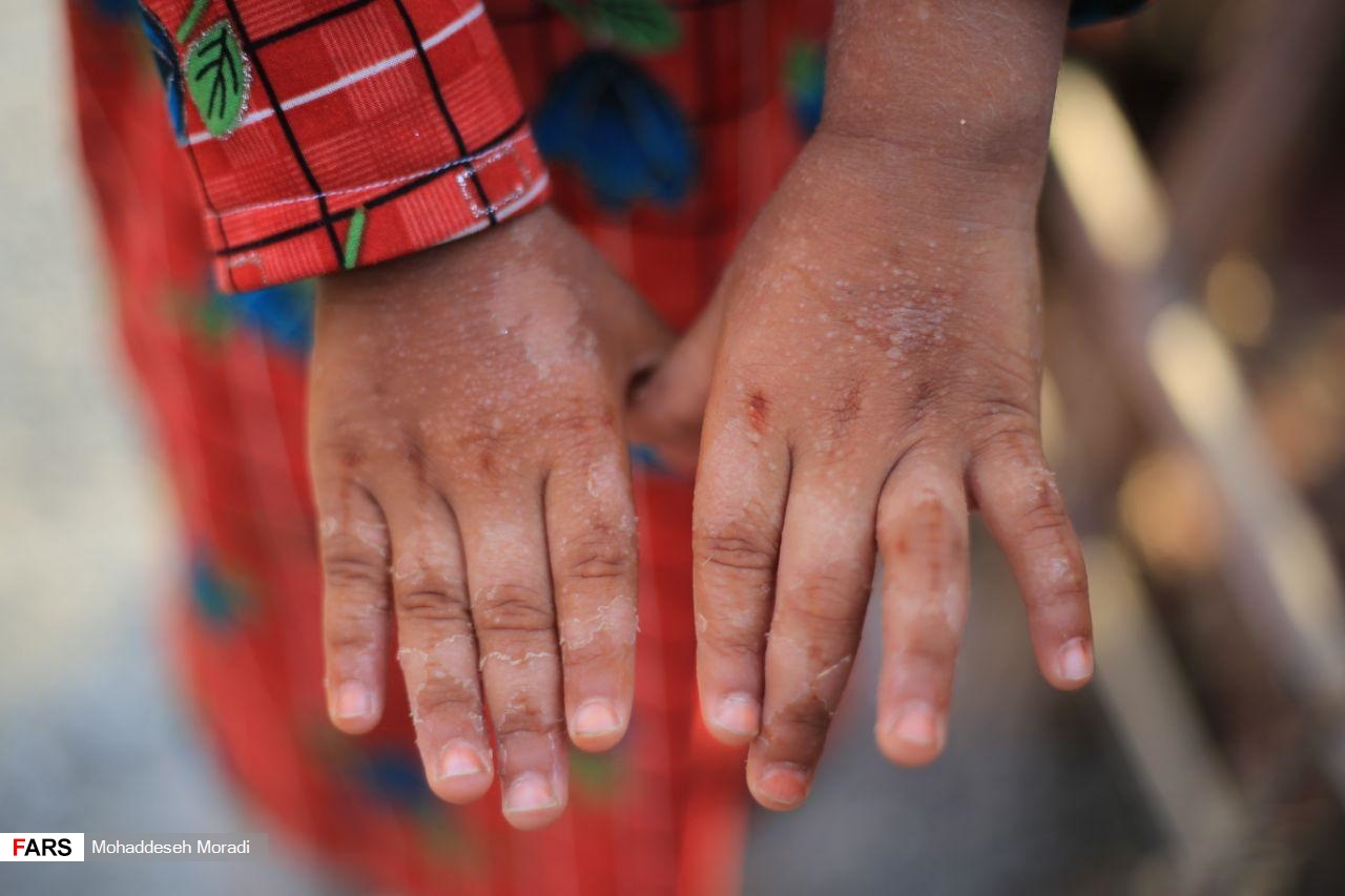 «زاچ و داربست» هم‌‌چنان در چادر