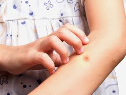 چرا جای گزیدگی پشه می خارد؟