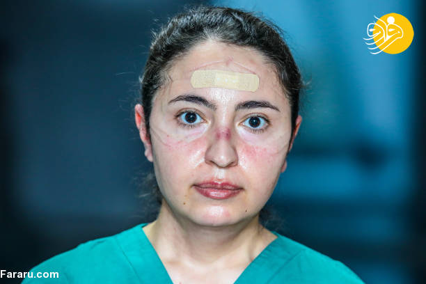 عکس/ اثر ماسک بر چهره پرستاران آذربایجانی