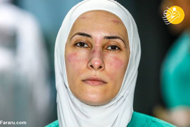 عکس/ اثر ماسک بر چهره پرستاران آذربایجانی