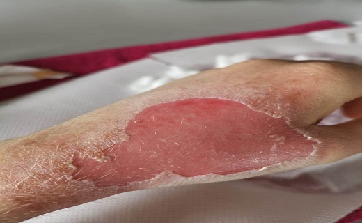 هشدار درباره استفاده از ژل‌های ضدعفونی کننده الکلی