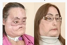 4گوشه دنیا/ مرگ نخستین زن جهان که صورت پیوندی داشت!