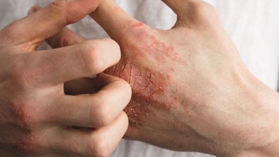 نکاتی درباره تاثیر کرونا بر پوست