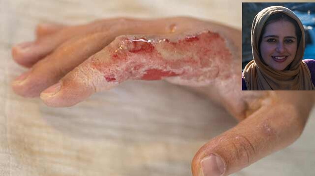 امکان بهبود ترمیم پوست پس از سوختگیهای شدید با تلاش دانشمند ایرانی