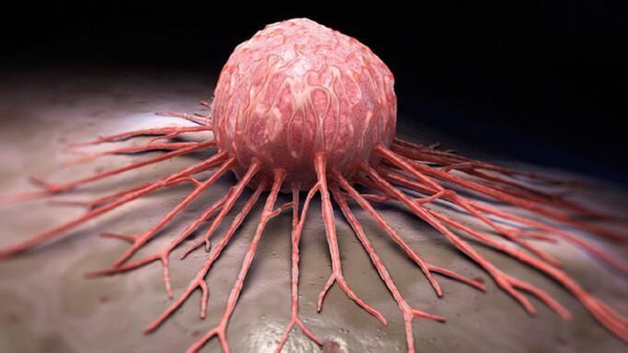 شبیه‌سازی مدلی جدید جهت پرتودرمانی سرطان سینه