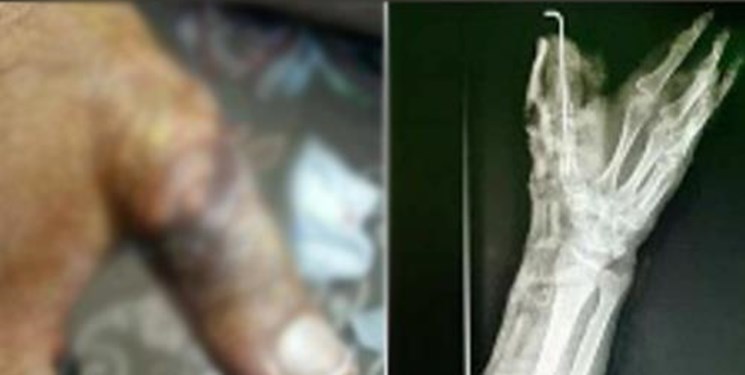 پیوند انگشت قطع شده در بیمارستان میناب