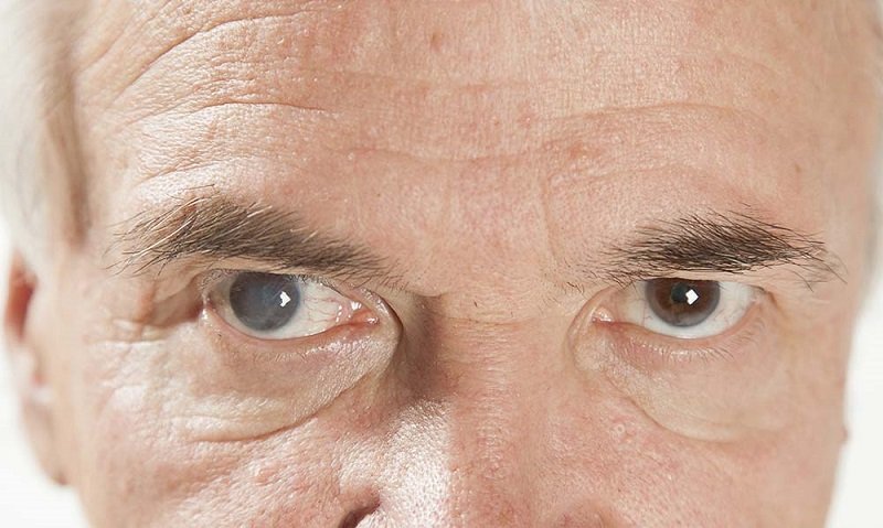 تفاوت آب سیاه چشم با آب مروارید چیست؟