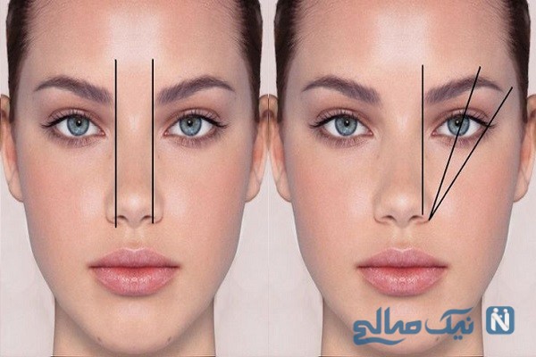 روش های رفع عدم تقارن در چشم ها، ابروها و پیشانی