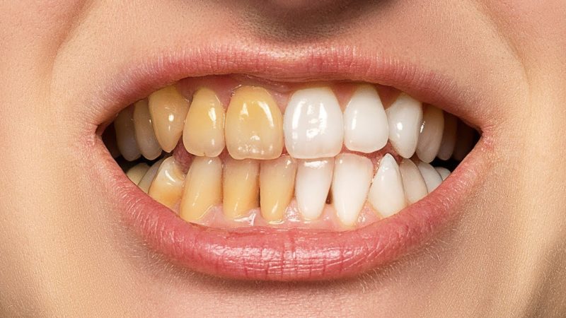 چگونه در فتوشاپ دندانها را سفید و درخشنده کنیم؟