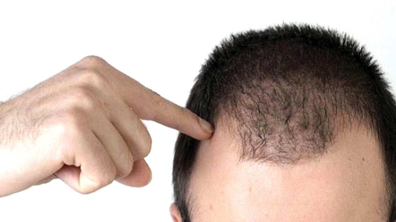 راه‌های پرپشت شدن مو در آقایان