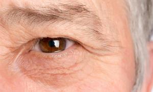 روش های درمان ورم اطراف چشم