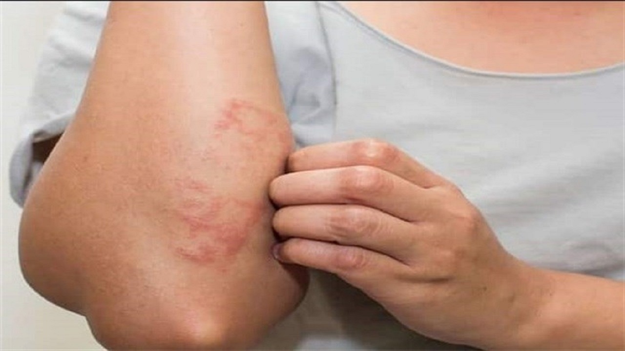خارش و آلرژی شدید؛ ارمغان مصرف ۹ ماده غذایی