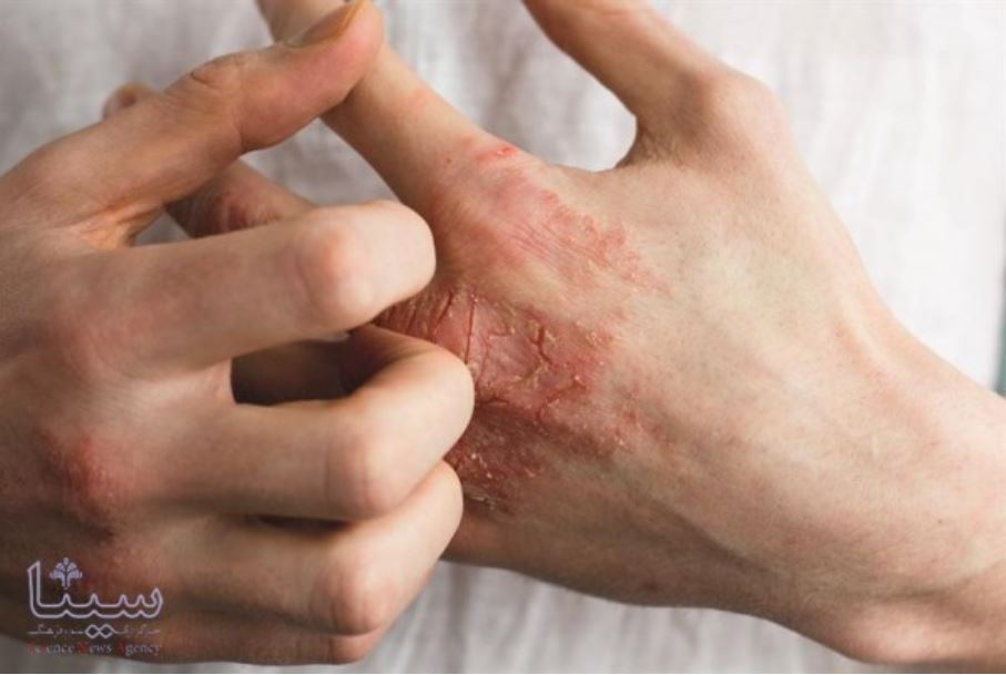 ترکیب حساسیت فصلی و استفاده دائم از ضدعفونی کننده ها؛ اگزما را در بهار جدی بگیرید