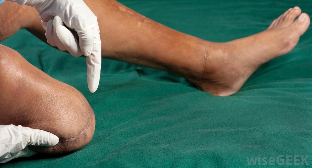 قطع کردن اشتباهی پای سالم یک بیمار توسط پزشکان اتریش!