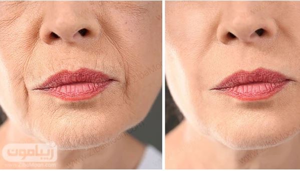 همه چیز درباره رفع چین و چروک صورت با لیزر