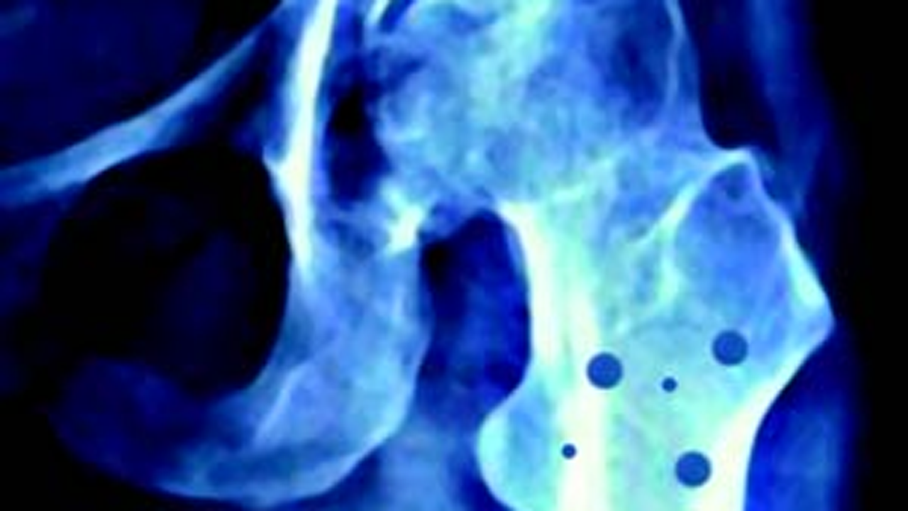 صفر تا صد بیماری پوکی استخوان