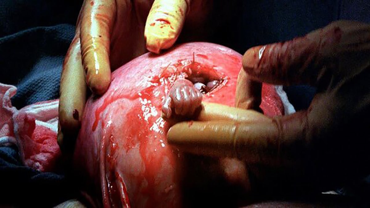 عکس/ جنینی که پیش از تولد دست جراحش را فشرد