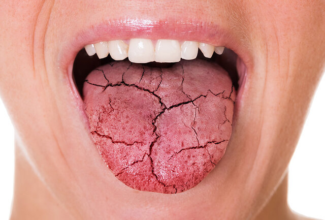 تاثیر میزان قند خون در ایجاد خشکی دهان