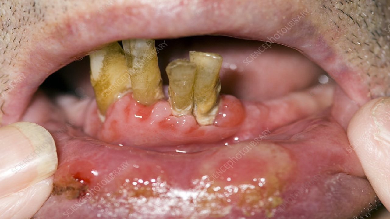 علائم دهانی که نشان دهنده بیماری‌های مخوف هستند