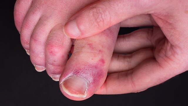 کرونا/ چرا برخی افراد به عارضه انگشت پای کوویدی مبتلا می شوند