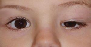 اینفوگرافی/ علت و درمان افتادگی پلک‌ چشم