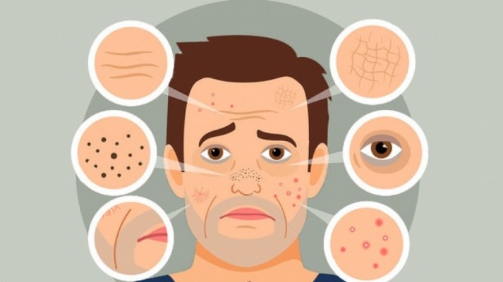 چگونه از شر جوش های سرسیاه خلاص شویم؟