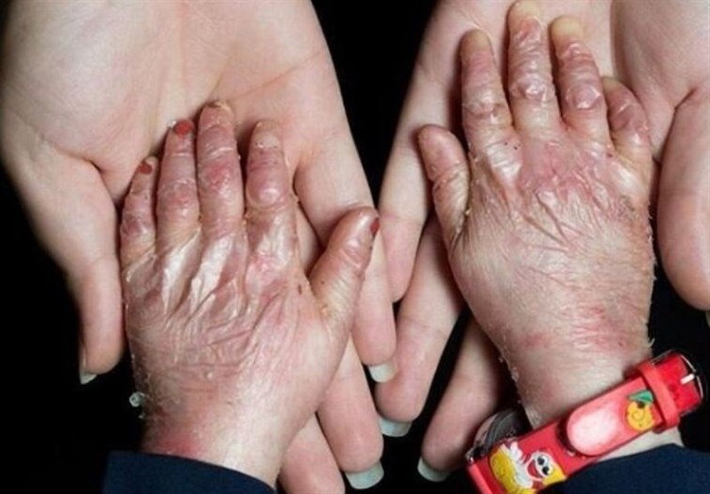 مشکلات بیماران پروانه‌ای کمتر می‌شود