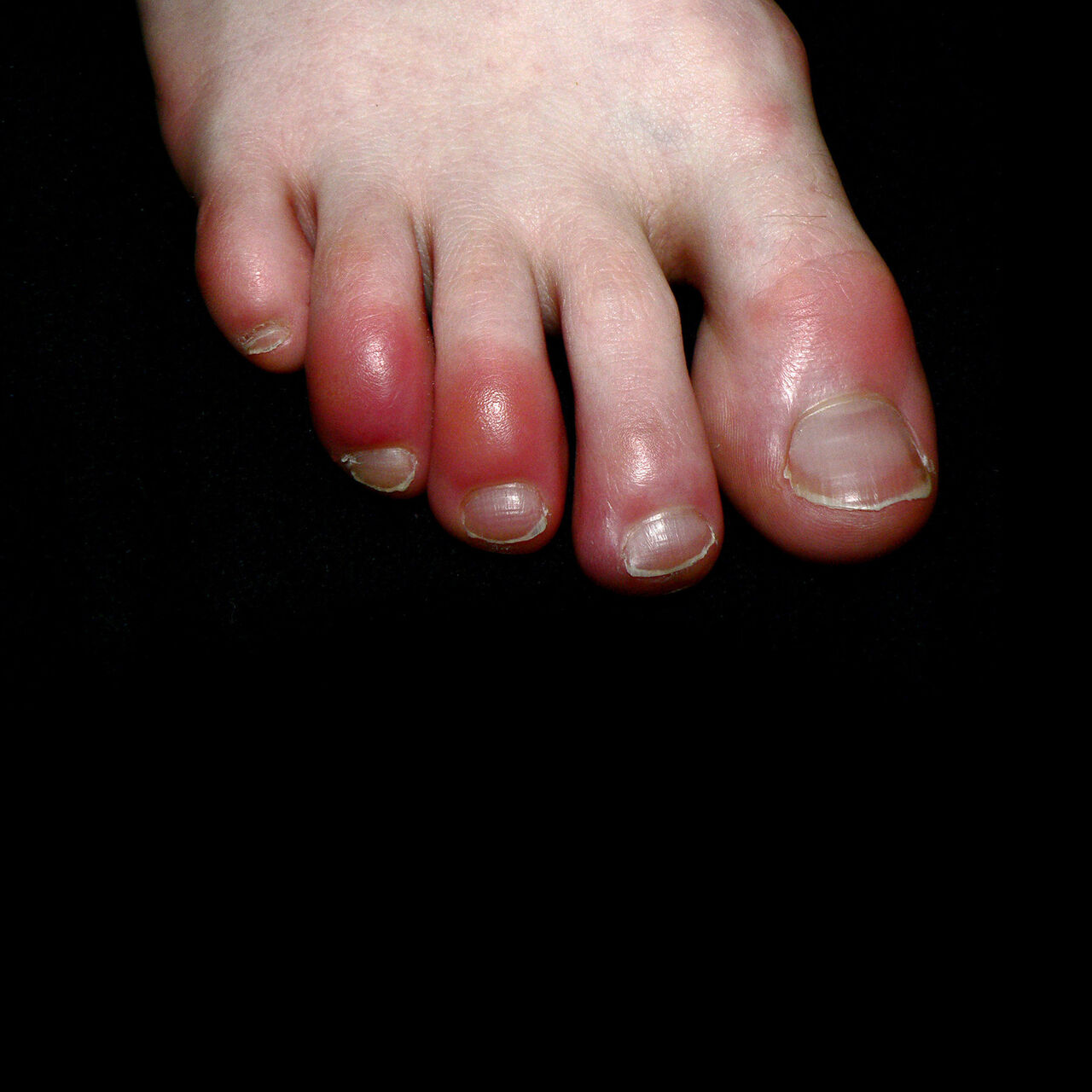 کرونا/ انگشت پای کوویدی؛ چیست و چرا ایجاد می‌شود؟  