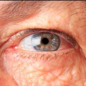 درمان تنبلی چشم سالمندان  