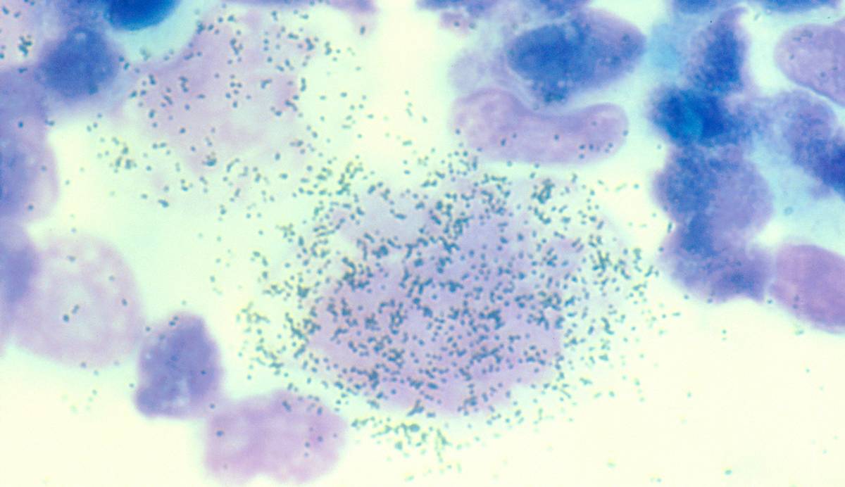 پژوهش دانشگاه هاروارد: ویروس هرپس احتمالا عامل اصلی ابتلا به ام‌اس است