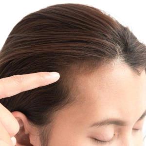 ریزش موی هورمونی به چه معناست؟ 