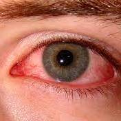 اینفوگرافی؛ قرمزی چشم دلیل چه بیماری هایی است؟