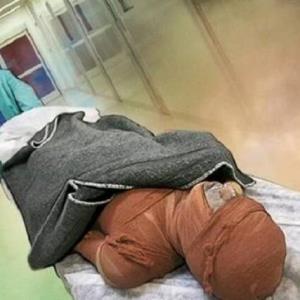 شیوع بالای مقاومت آنتی‌بیوتیکی در بیماران سوختگی در ایران