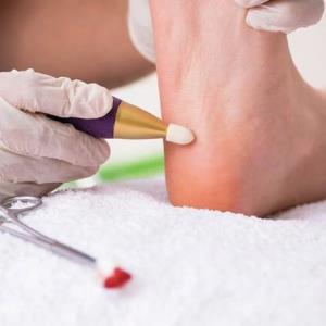 درمان یکی از بیماری‌های دردناک پا با تزریق چربی