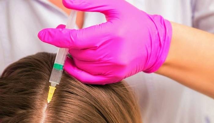 همه چیز درباره فیلر مو؛ روش نوین تقویت موی سر