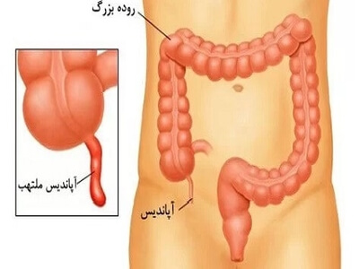 علامت و درمان آپاندیس