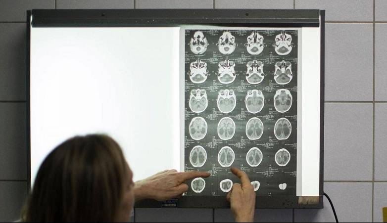 کرونای خفیف هم به مغز رحم نمی‌کند!  