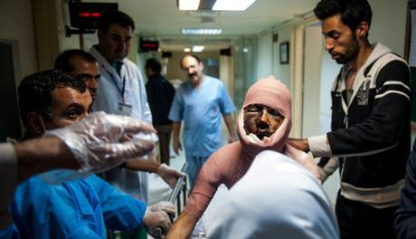 وضعیت بد سوختگی و درمان آن در کشور