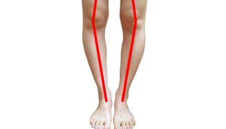 برای درمان پای پرانتزی چه اقداماتی باید انجام داد؟