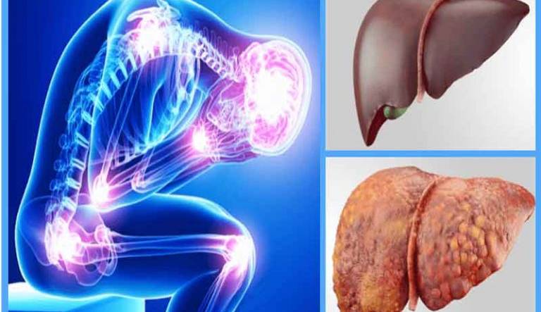 ارتباط آسیب کبد با شکستگی‌ استخوان  