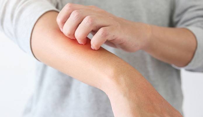 کرونا/ واکنش های پوستی ناشی از کووید 19بیشتر از واکنش پوست به واکسن است