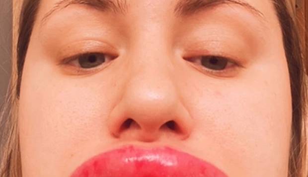 تزریق ژل دردسر ساز شد؛ تبدیل لب به سوسیس!
