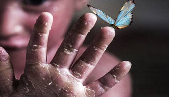 راهی برای درمان افراد مبتلا به بیماری پروانه ‌ای