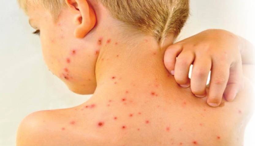 راه های پیشگیری از جولان سرخک