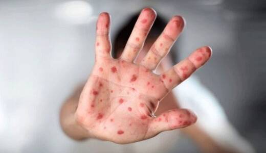 احتمال مبتلاشدن بزرگسالان به سرخک چقدر است؟  