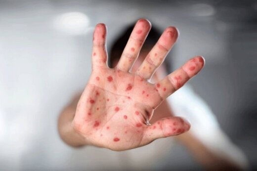احتمال مبتلاشدن بزرگسالان به سرخک چقدر است؟