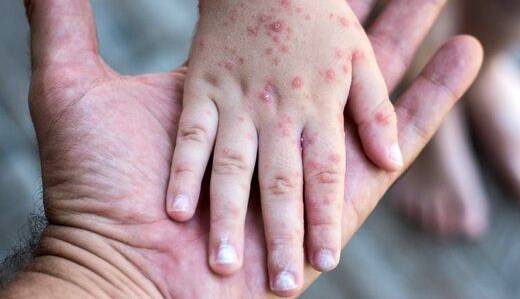ابتلا به سرخک در بزرگسالان هم وجود دارد؟