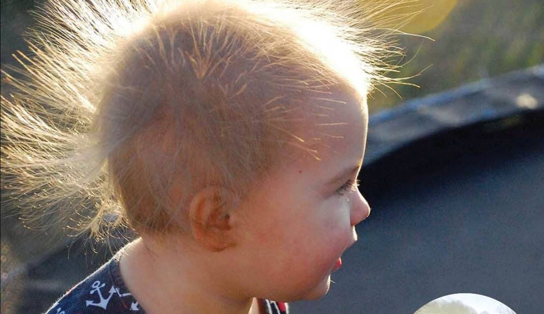 سندرومی که باعث معروف شدن یک کودک شد